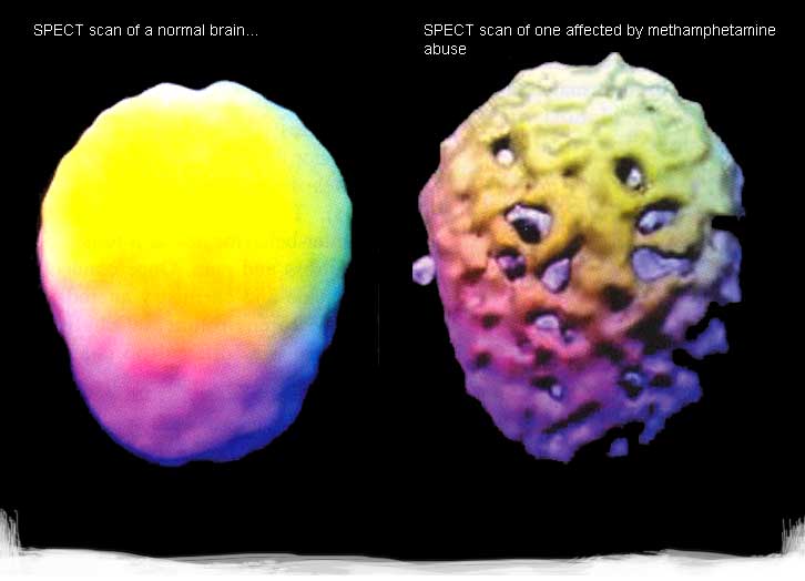 After brain. The American ad “this is your Brain on drugs”. After Brain Demo.