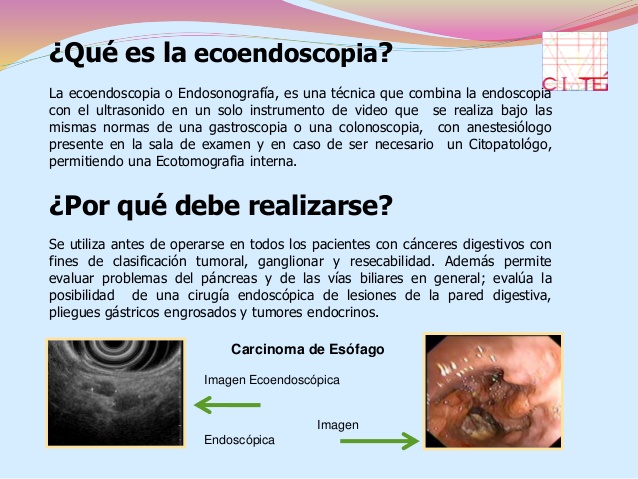 Condenan al Sescam a pagar 45.000 euros por la muerte de una paciente que se sometió a una ecoendoscopia