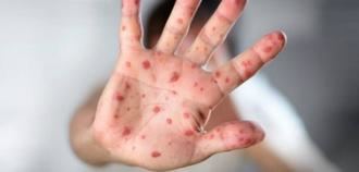 Atención, Guadalajara registra un brote epidemiológico de sarampión