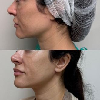 El Dr. Albert Bosch introduce el microlifting, la nueva tendencia estética en España