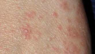 ATENCIÓN, Brote de sarna en el Colegio de Yebes-Valdeluz