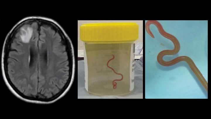 Descubren un gusano vivo de 8 centímetros en el cerebro de una mujer 