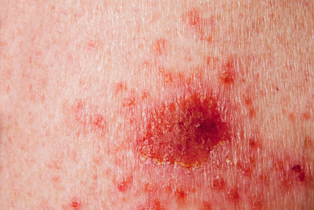Más de 78.000 personas sufren cáncer de piel al año 