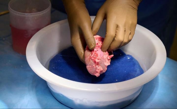 Cae una banda en Pakistán que vendió más de 300 riñones de personas pobres a pacientes adinerados