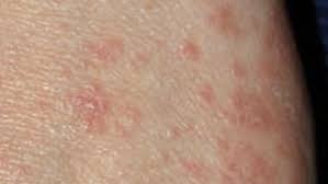 Detectados 44 brotes de sarna en Baleares, 11 de ellos vinculados a centros educativos