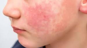 ¿Qué es el virus de la bofetada en niños?