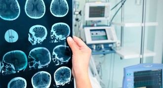 Impacto del Alzheimer en el cerebro: cambios y áreas afectadas
