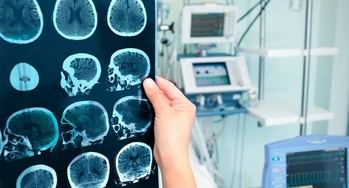 Impacto del Alzheimer en el cerebro: cambios y áreas afectadas