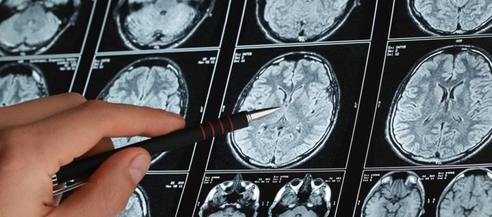 Descubren patrón molecular que podría mejorar la detección del párkinson