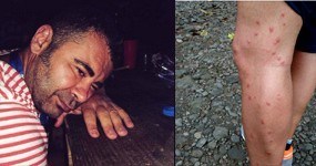 Jorge Javier Vázquez #palarrastre atacado por los mosquitos polinesios