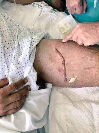 Iván Fandiño ya se recupera de la cornada sufrida en Úbeda el pasado domingo