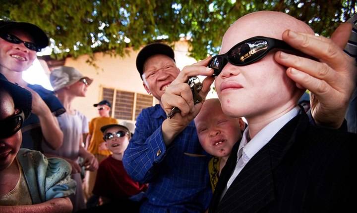 Profesionales del Hospital de Guadalajara recogen de gafas de sol para la población albina de Tanzania